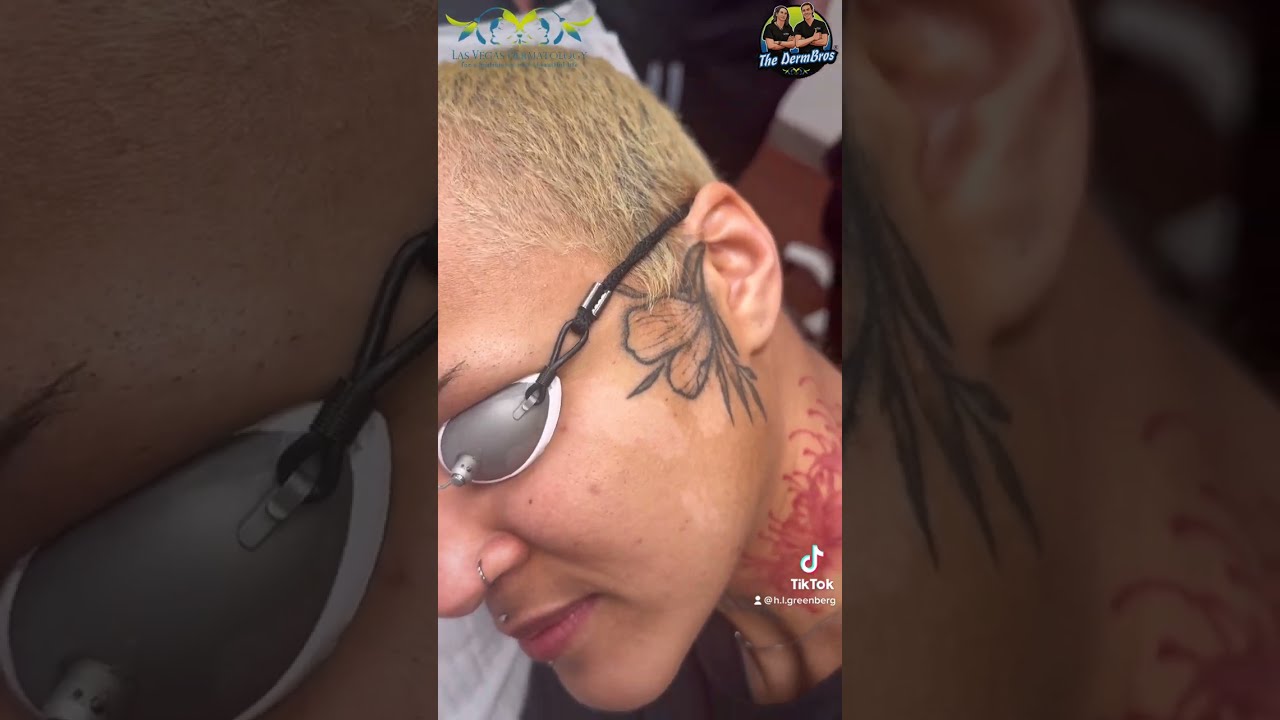 Face Tattoo 💥 Laser ⚡️ Tattoo Removal Treatment  #✌🏻 two. Jasmin visits Las Vegas Dermatology