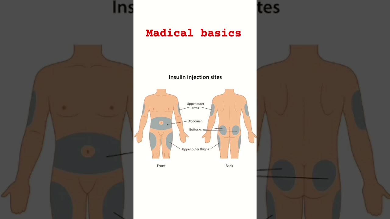 site's of insulin injections 