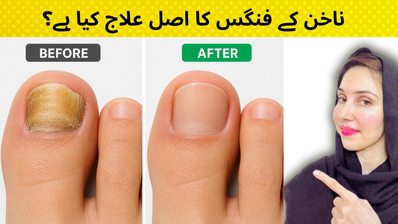 Toenail Fungus: The MOST Effective Way to Treat It Naturally