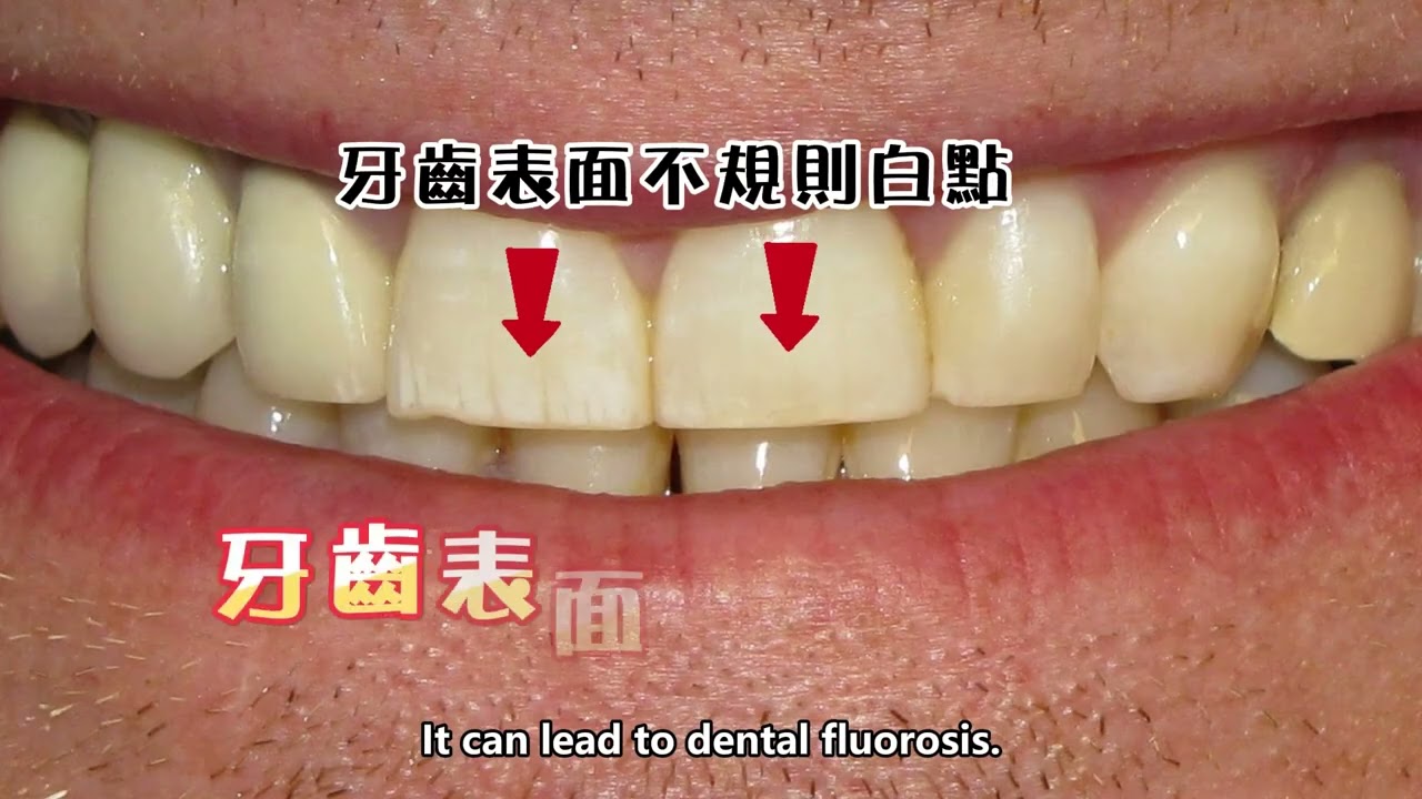 【氟化物被美國FDA禁了？大仁哥牙醫來解釋！】