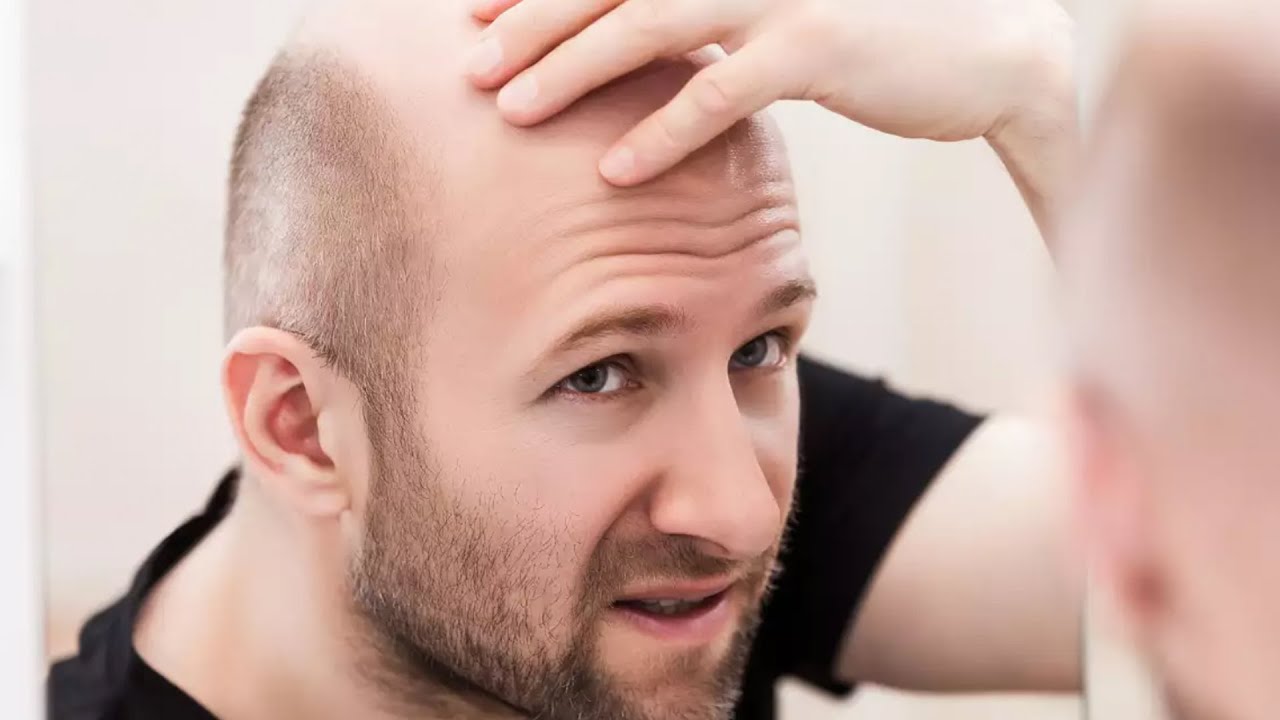 ليه الصلع بيحصل دايما من مقدمة الرأس مش من الأجناب؟
