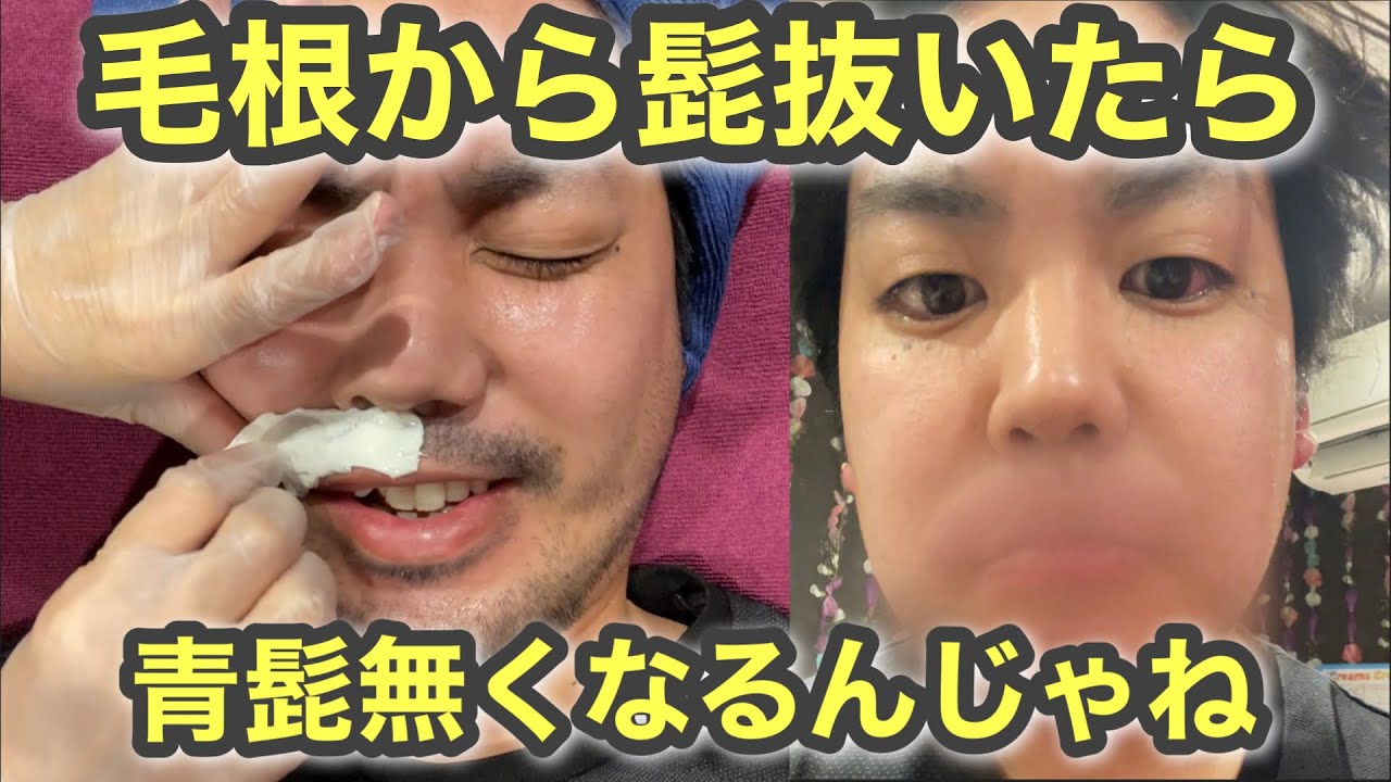 【閲覧注意】髭Wax脱毛で青髭無くせるんじゃない？