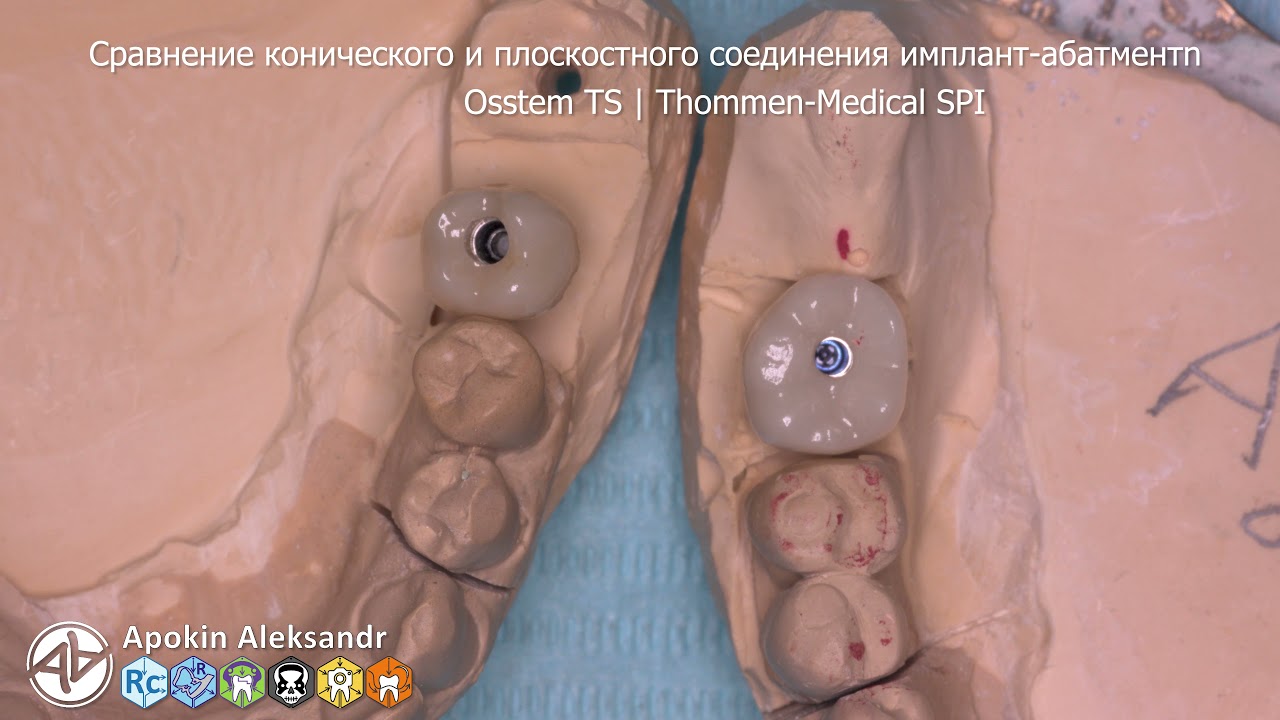 Сравнение конического и плоскостного соединения имплант-абатмент (Osstem Thommen) 4K