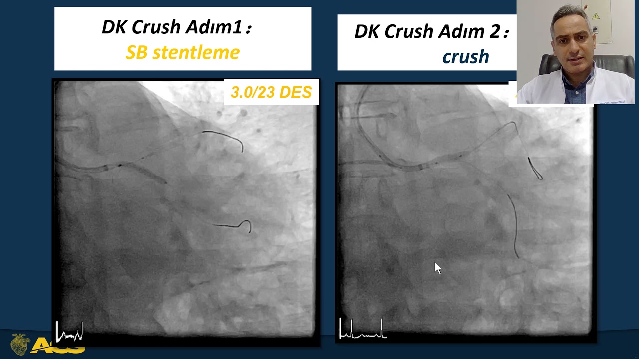 Doğru DK Crush Stentleme Nasıl Yapılmalı ?