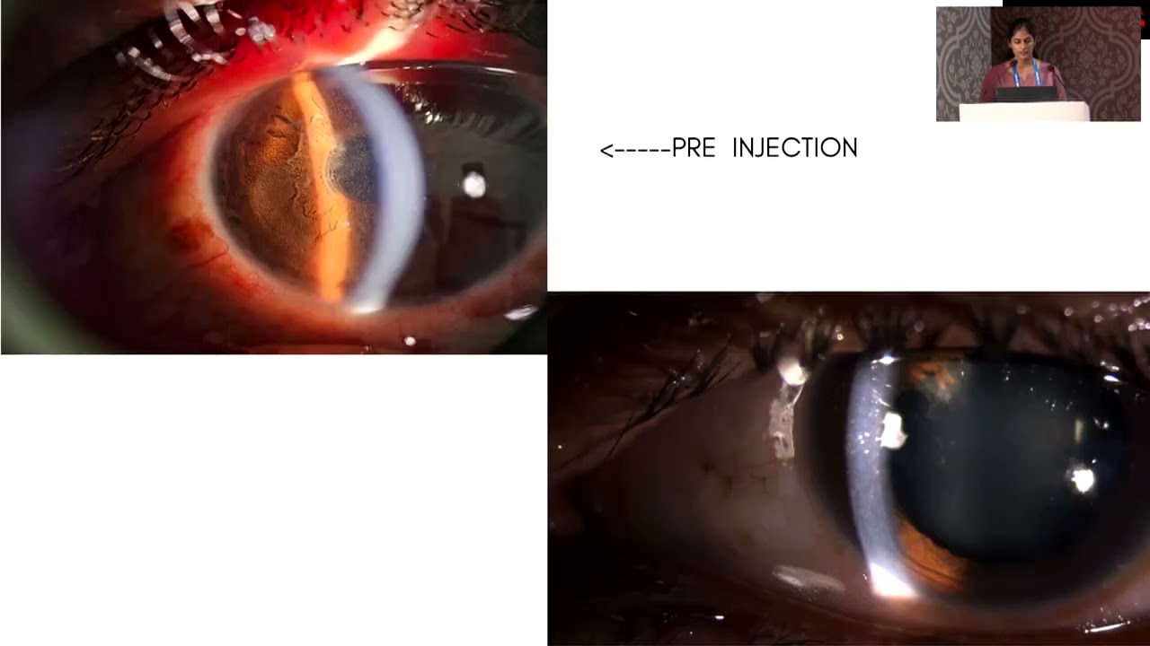 AIOCMTC4 2025   FP332 Dr  Asmita Rastogi   Iris Pigments deposition over Anterior Lens Capsule  A