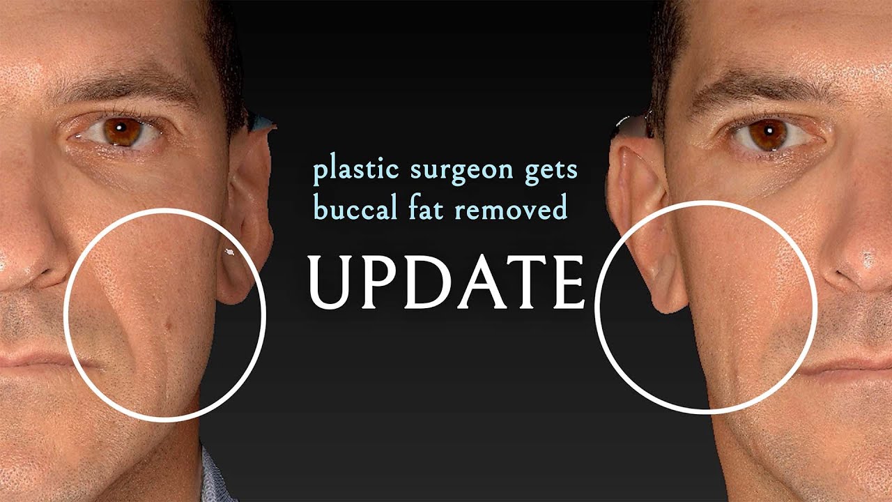 Dr. Zelken gets buccal fat pad removal: 1 month UPDATE