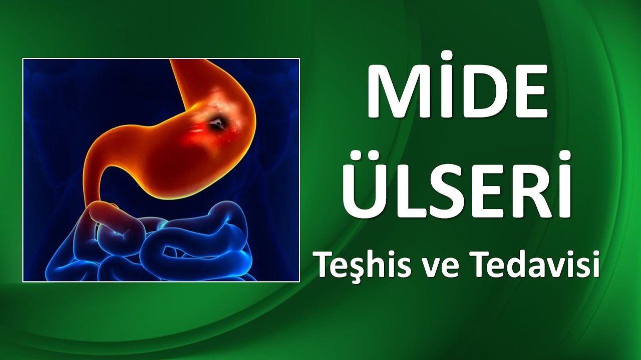 MİDE ÜLSERİ TEŞHİS VE TEDAVİSİ