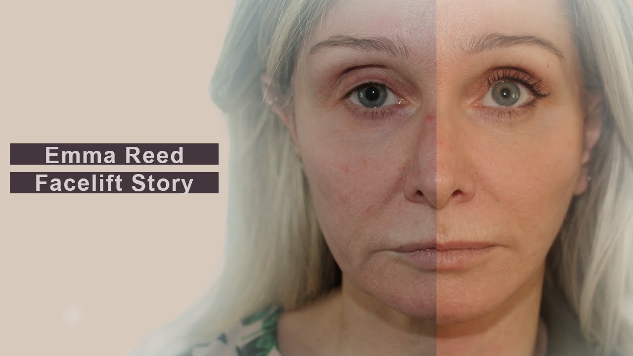 Emma Reed's Facelift Journey at Karidis Clinic