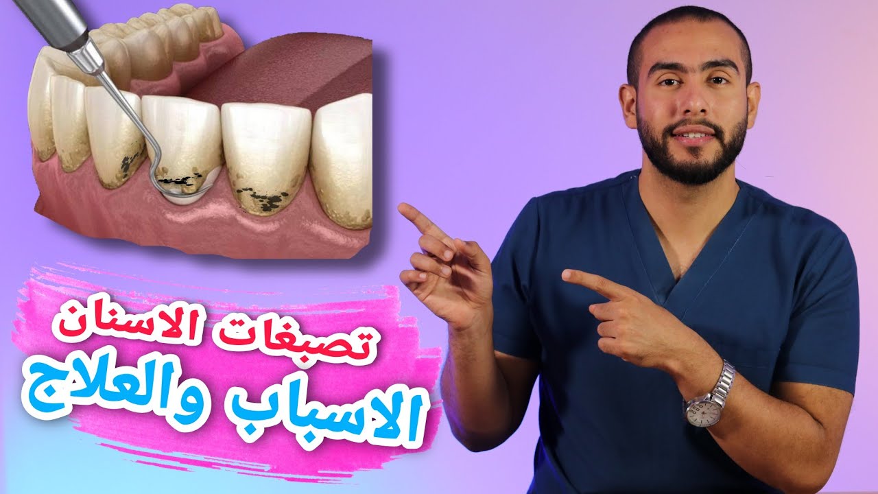 تصبغات الاسنان السوداء اسبابها وعلاجها 🦷💯علاج تصبغات الاسنان عند الاطفال🥳علاج تصبغات الاسنان بالليزر