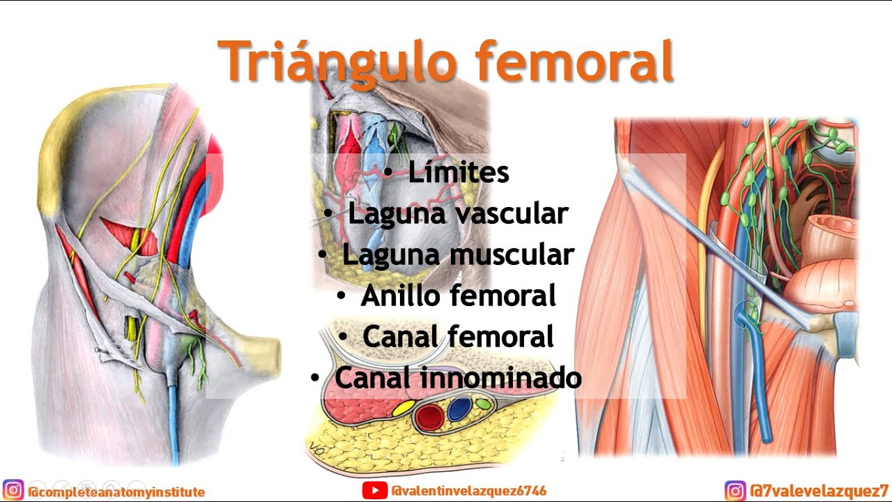 TRIÁNGULO FEMORAL [de Scarpa] - (Laguna vascular, laguna muscular, vaina femoral, anillo femoral)
