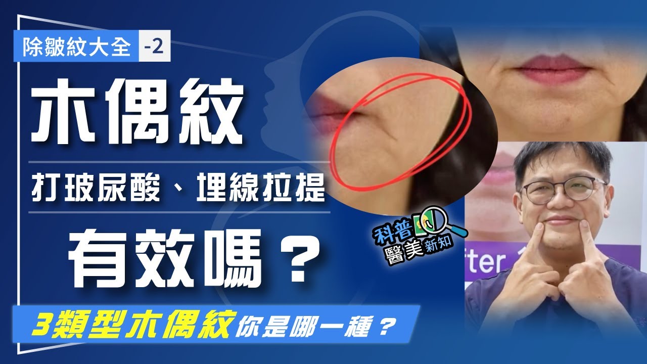 除皺紋大全-2｜木偶紋、嘴角下垂 打玻尿酸、埋線拉提有效嗎？ 先搞懂3類型木偶紋  你是哪一種？ 科普醫美新知379-20250221