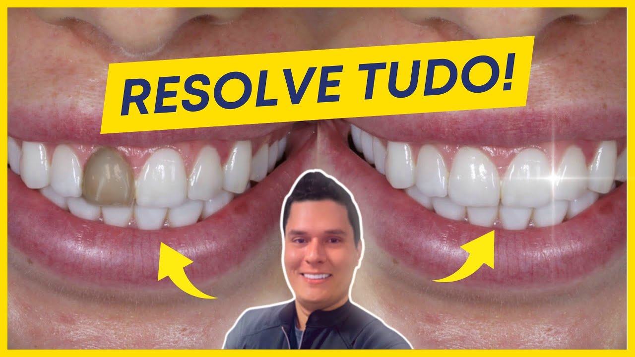 DENTE ESCURO - O QUE FAZER? COMO CLAREAR?