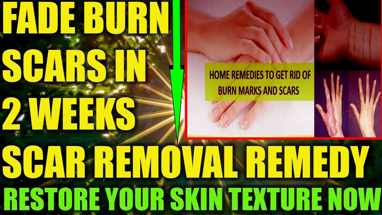 How To Fade Burn Scars Naturally: How To Remove Old Scars Fast After Boiling Water Burn
