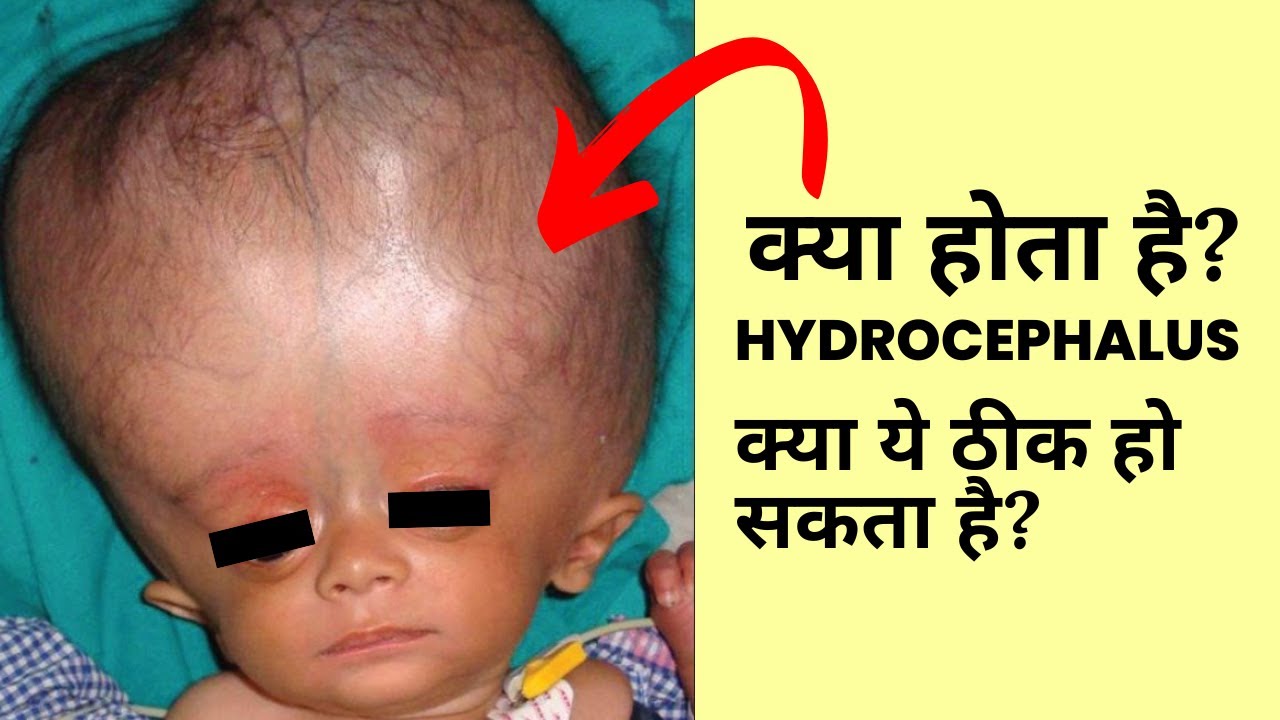 Hydrocephalus | Causes, Symptoms, Diagnosis and Treatment | Dr. Surendra Gupta