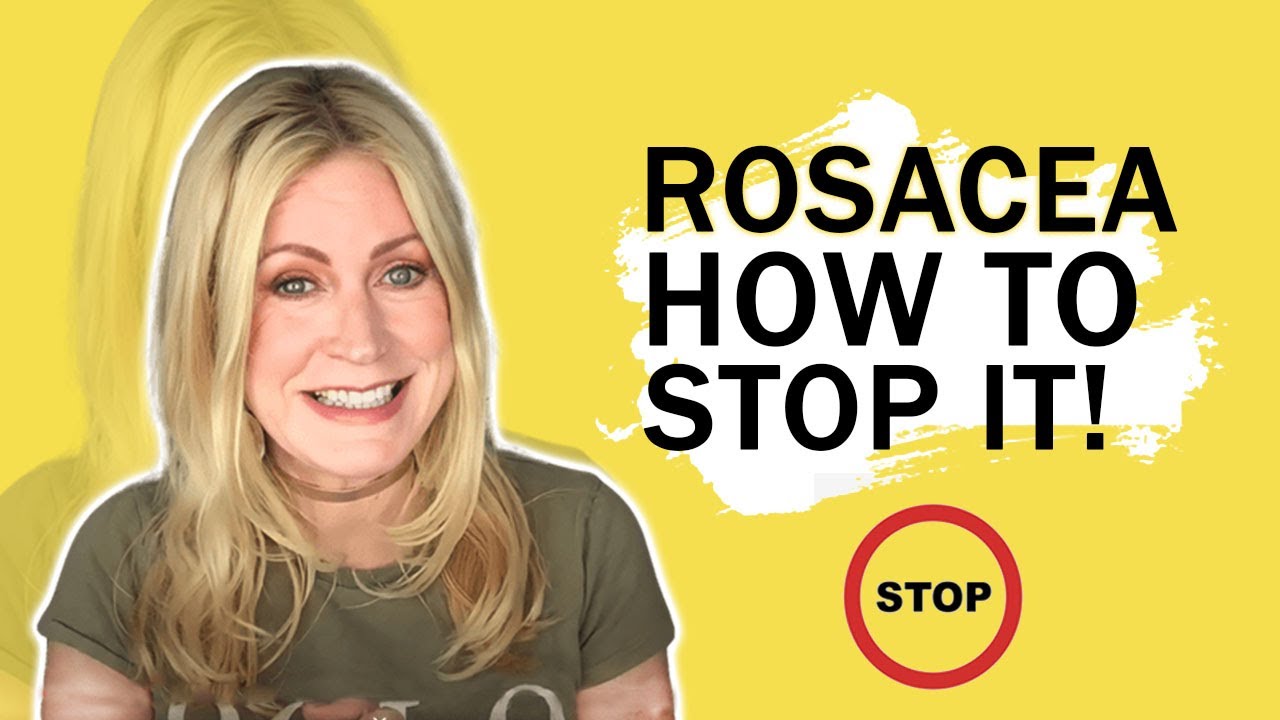 Rosacea....Cure it Now!