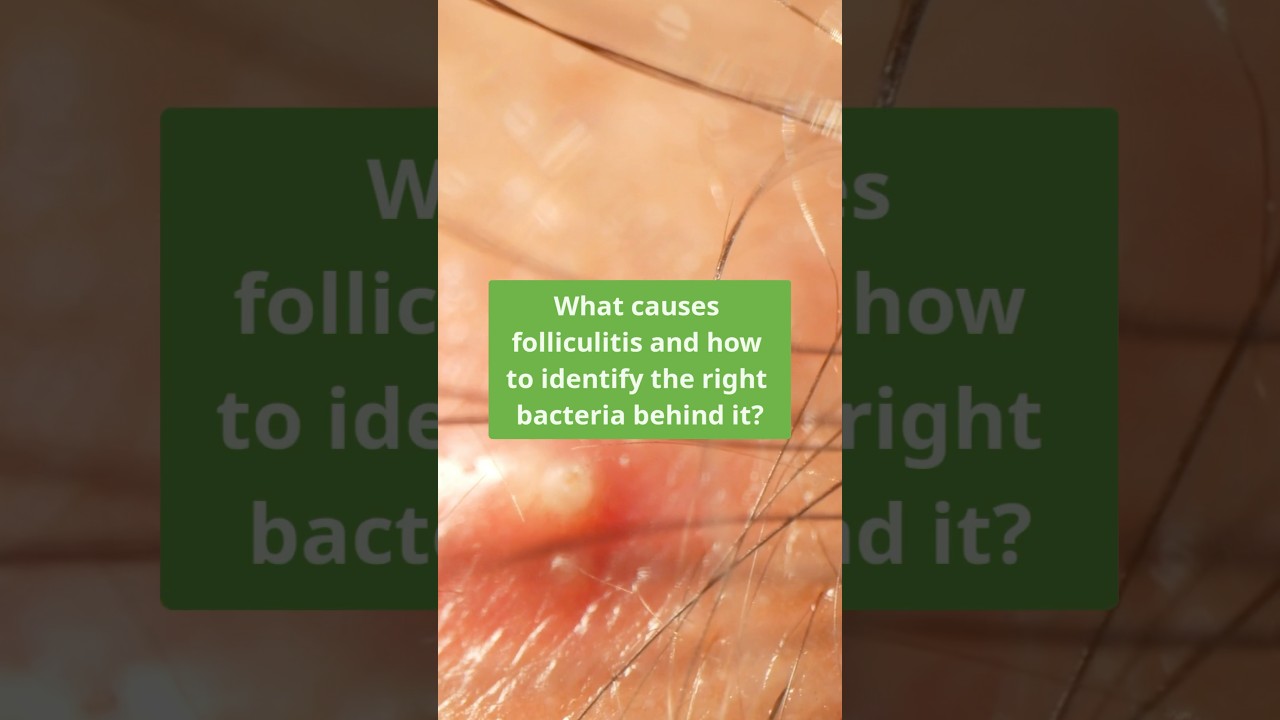 Is Your Patient's Folliculitis Caused by Staph? Find Out 🔍