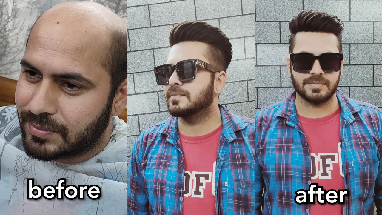 Hair transformation by hair solution  punjab (9888015815) ludhiana, Jalandhar, Amritsar , chandigarh