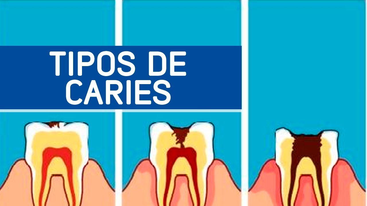 Tipos de caries / Odontoespecialistas