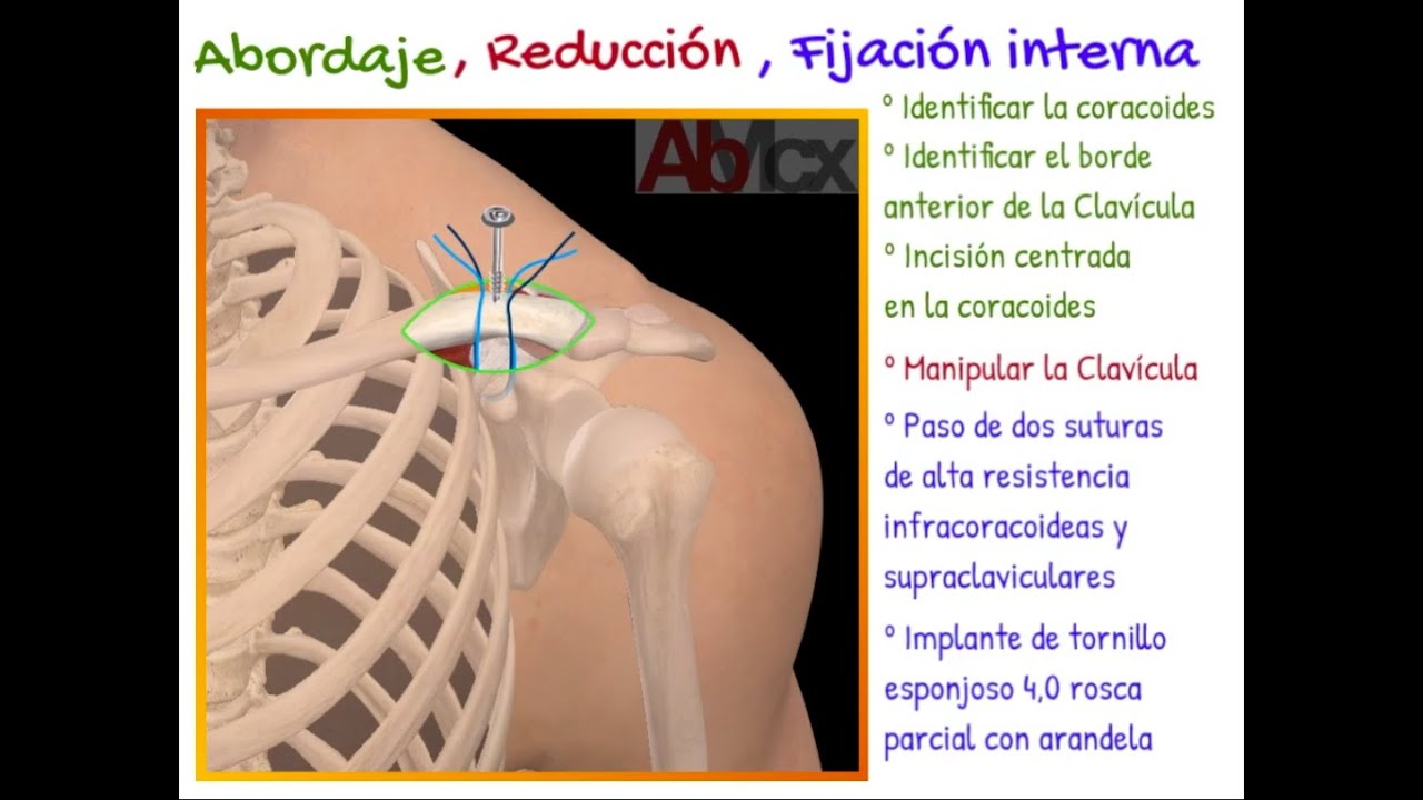 LUXACION ACROMIOCLAVICULAR - UNA TECNICA QUIRURGICA COMBINANDO BOSWORTH Y LAZADAS CORACOCLAVICULARES