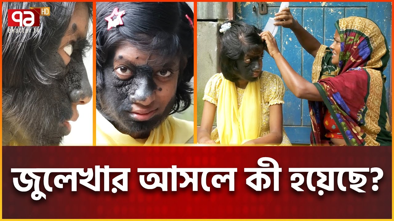 জুলেখা কেন আলোতে আসতে ভ/য় পায়? | Rare Diseases | Ekattor Special
