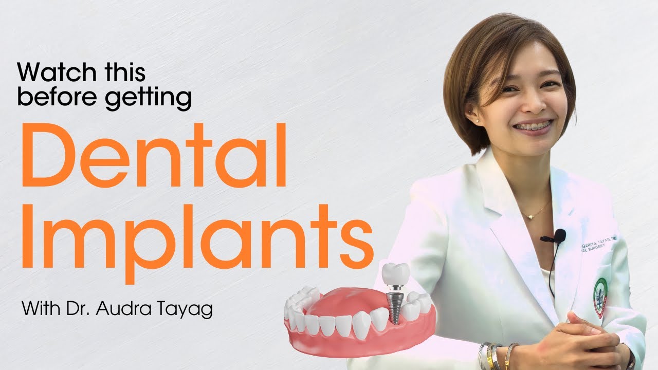 Urban Smiles Dental Clinic Teeth Talk Episode 5: Dental Implants