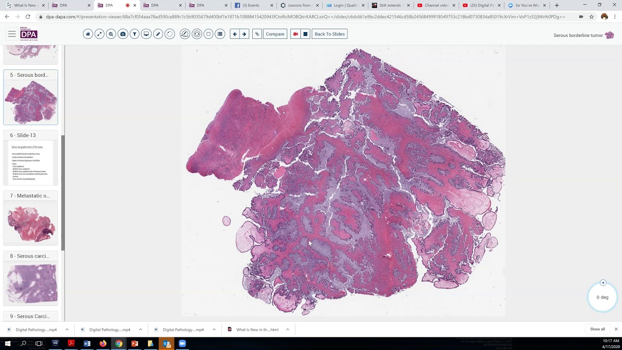 Serous borderline tumor of the ovary
