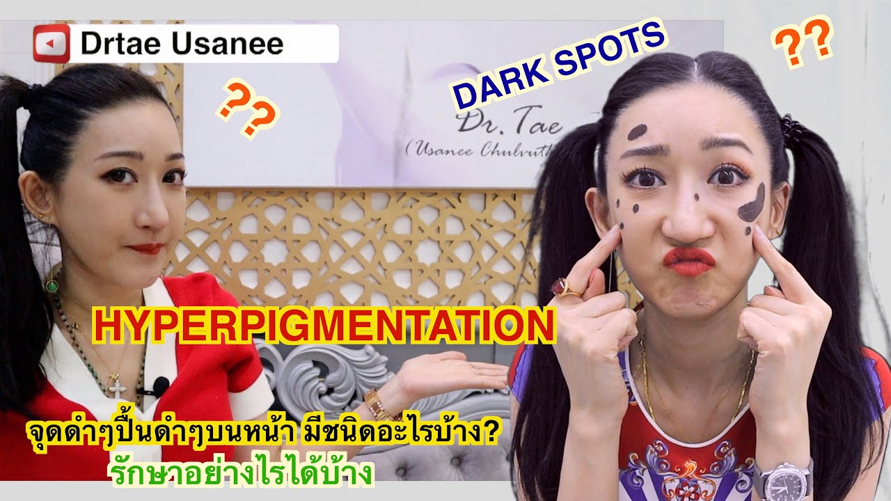 Dark spot /Hyperpigmentation รอยดำชนิดต่างๆบนใบหน้า รักษาอย่างไร หมอเต้อธิบายอย่างละเอียดยิบบ