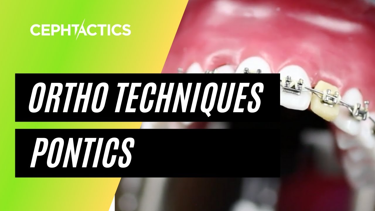Pontics (Immediate, Chairside) in Orthodontics