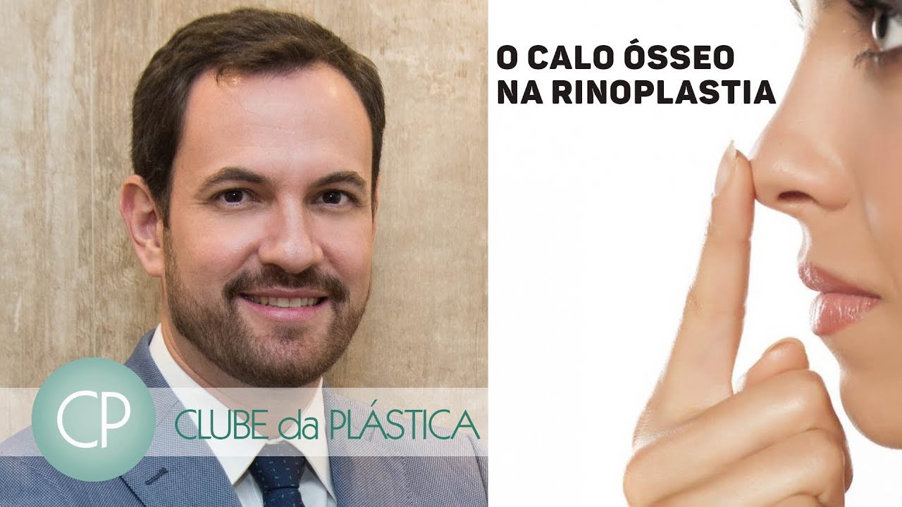 Clube da Plástica - O calo ósseo na rinoplastia