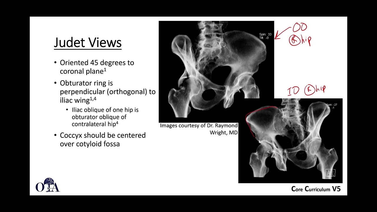 Radiographic evaluation of acetabulum fractures 1 (normal anatomy) - OTA CCv5