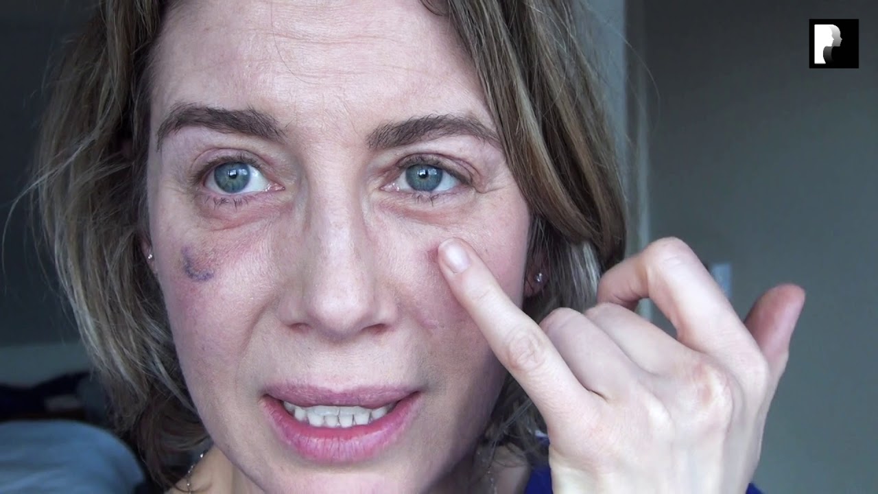 Blepharoplasty Video Diary - Day 26 After Surgery (14 of 15)