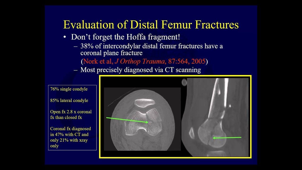 Distal femur fractures - Assessment and pre-op planning (OTA lecture series III l5a)