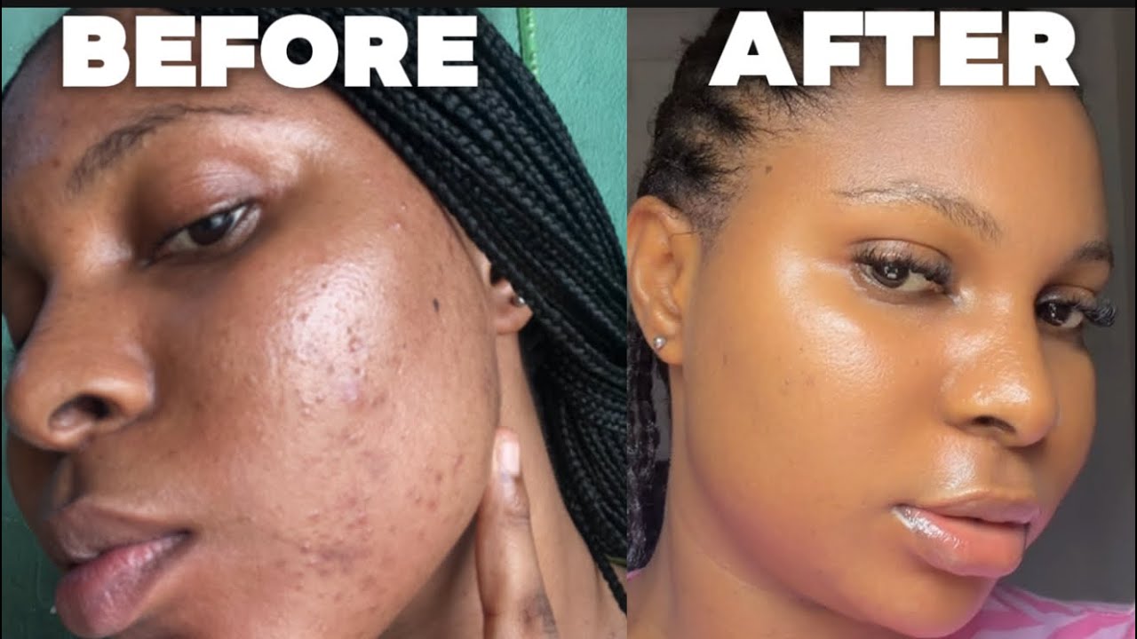 I Got Smooth Skin In Weeks : Here’s My Exact Routine 