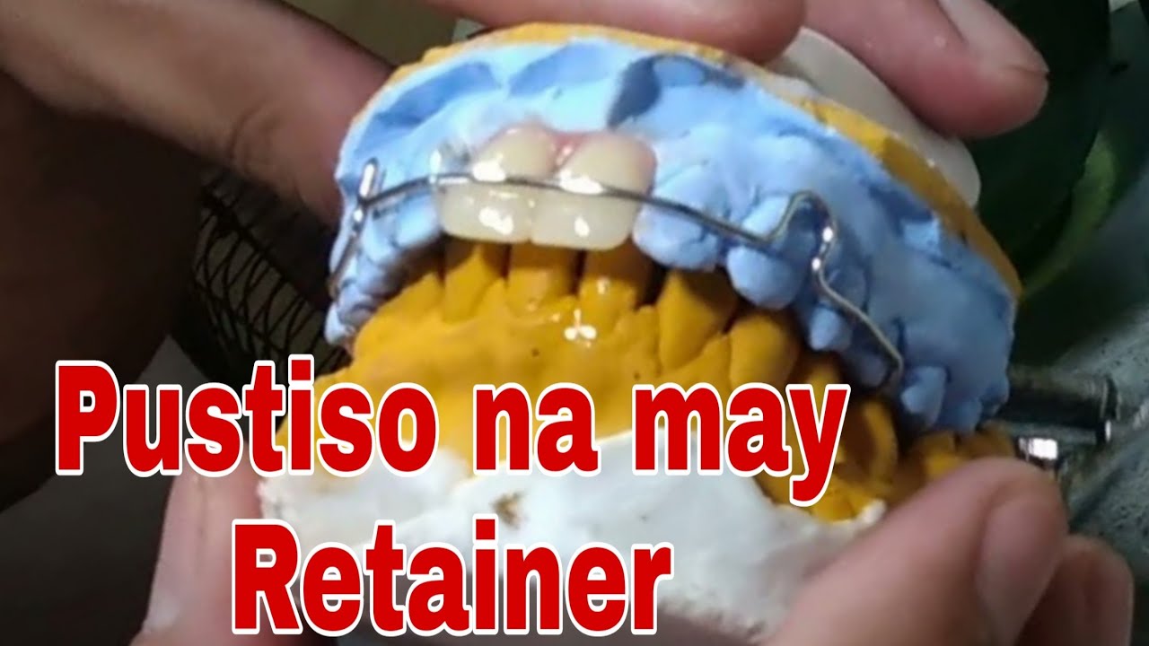 Denture/Pustiso with Retainer How you like that. Retainer in the Philippines.