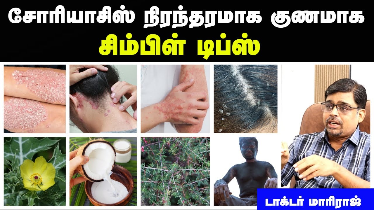 சோரியாசிஸ் நோய் அறிகுறிகள் | Psoriasis treatment in tamil | படை நோய் குணமாக | Doctor interview tamil