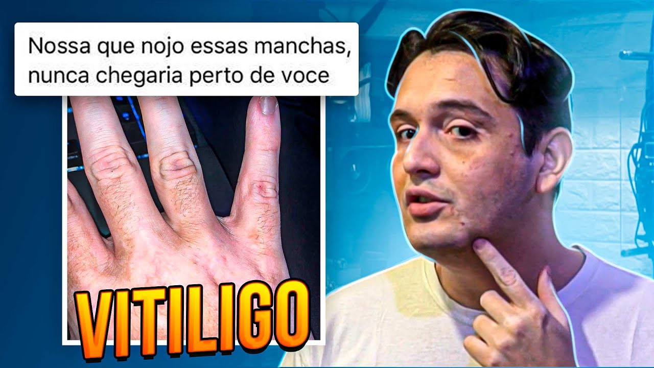MEU VITILIGO É CONTAGIOSO? A VERDADE SOBRE ESSA DOENÇA 🏥