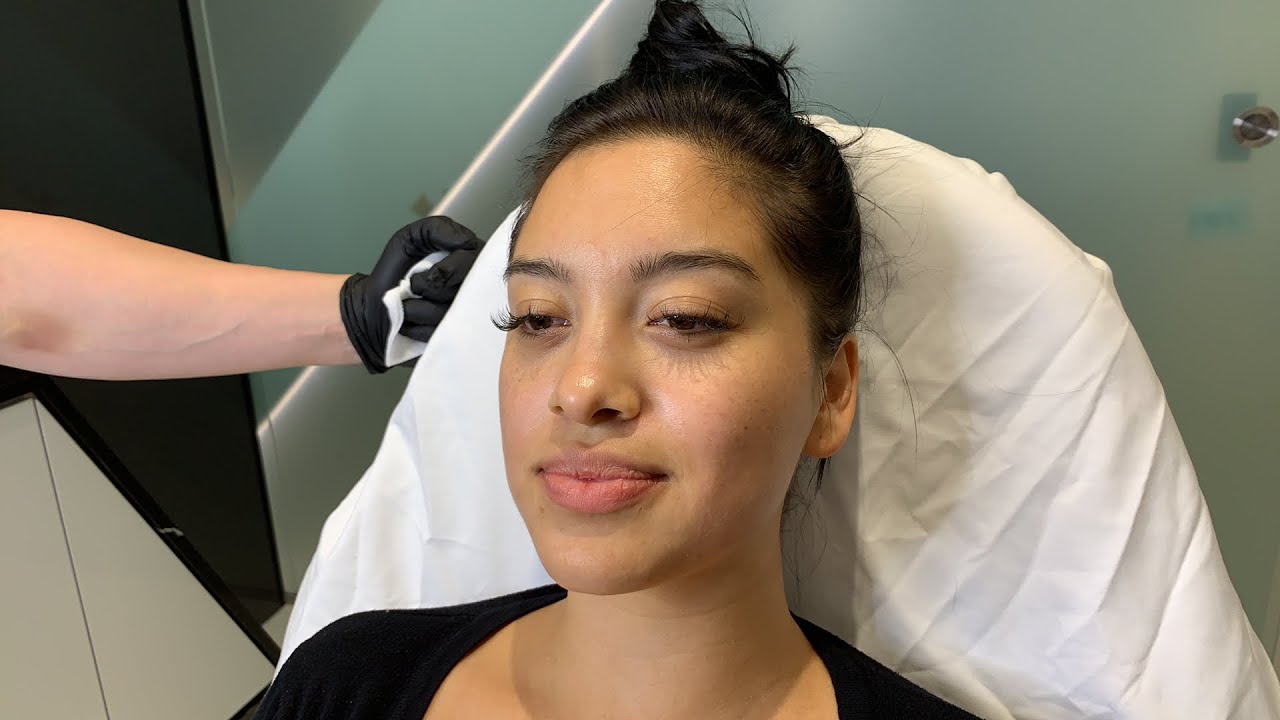 Female Facial Sculpting | Dermal Fillers | Cheeks, Chin and Laugh Lines | West Hollywood, CA