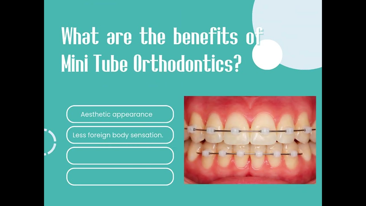 What is Mini Tube Orthodontics? 