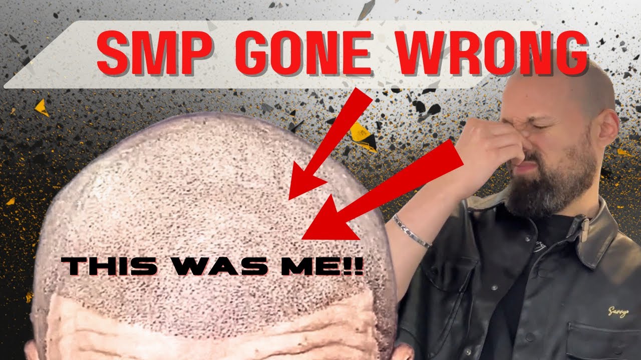 Bad SMP in the UK | Laser Removal and Second Attempt