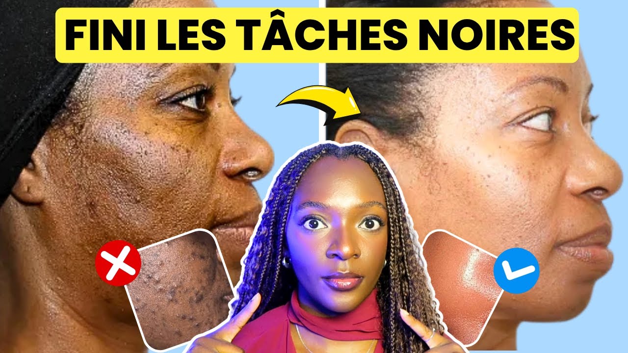 Comment &Eacute;LIMINER les t&acirc;ches noires sur le visage - GUIDE COMPLET 2025