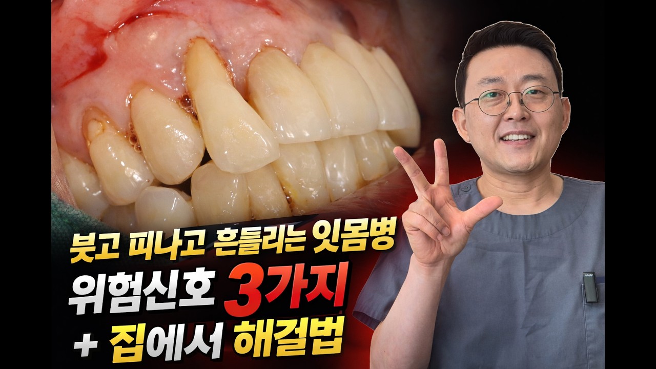 붓고 피나고 흔들리는 잇몸병 l 위험신호 3가지 + 집에서 해결법