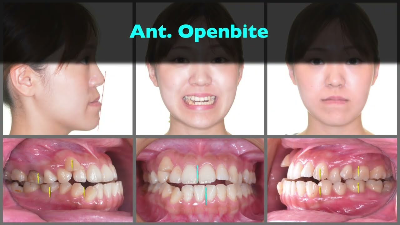 Solving class III with anterior open bite by aligners｜【Chris Chang Ortho】CC703