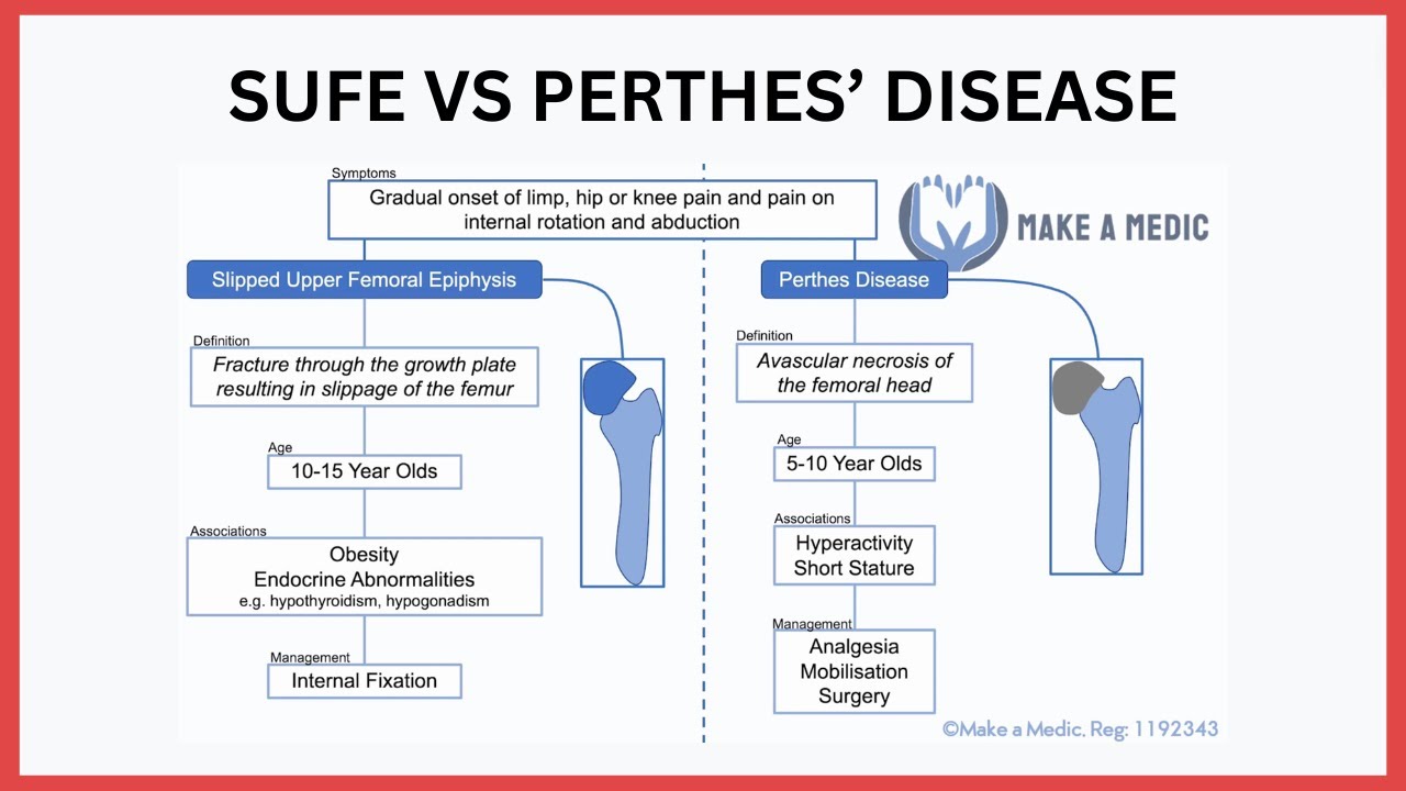 Slipped Upper Femoral Epiphysis (SUFE) vs Perthes Disease
