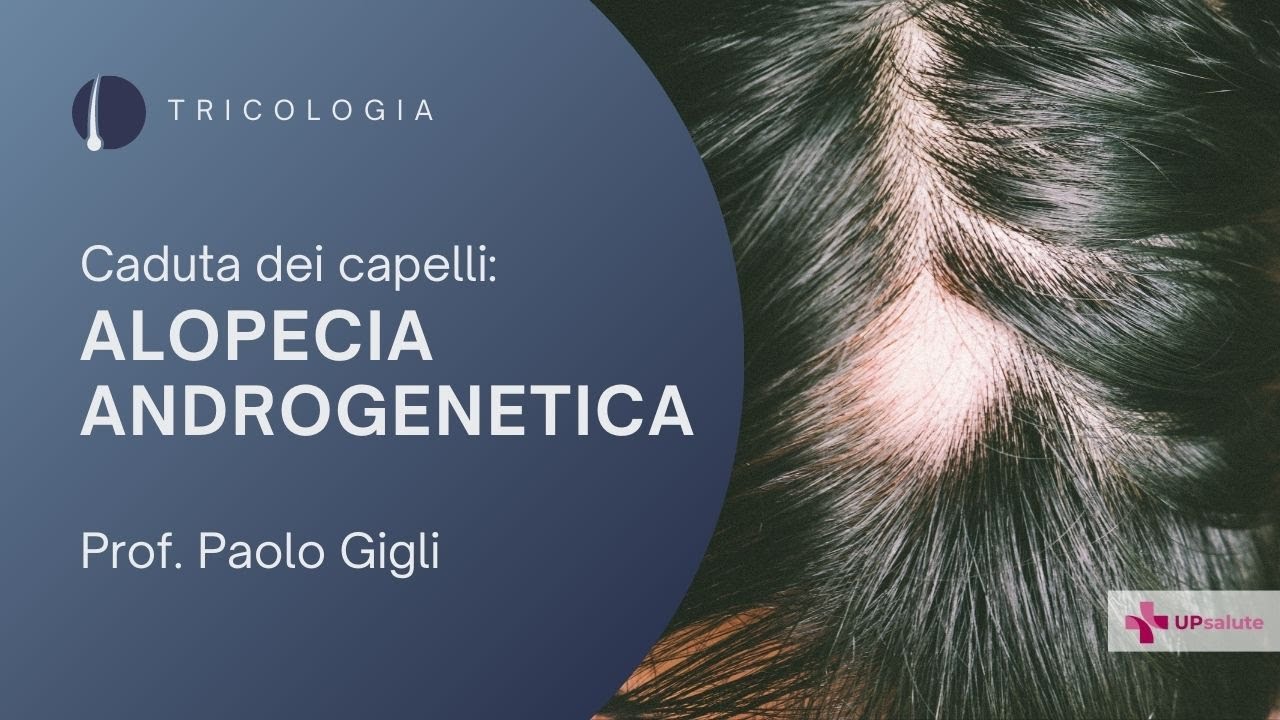 Alopecia androgenetica - Prof. Paolo Gigli - UPsalute Channel