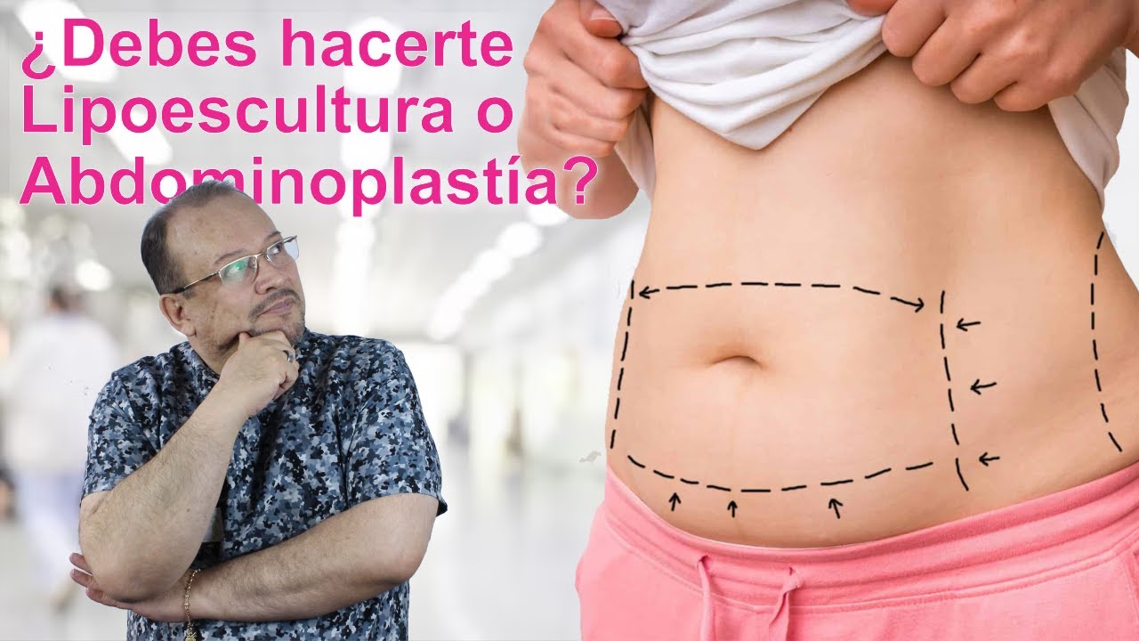 LIPOABDOMINOPLAST&Iacute;A o LIPOESCULTURA: &iquest;Qu&eacute; me debo hacer? 🤩 DR ALBERTO CALVO QUIROZ