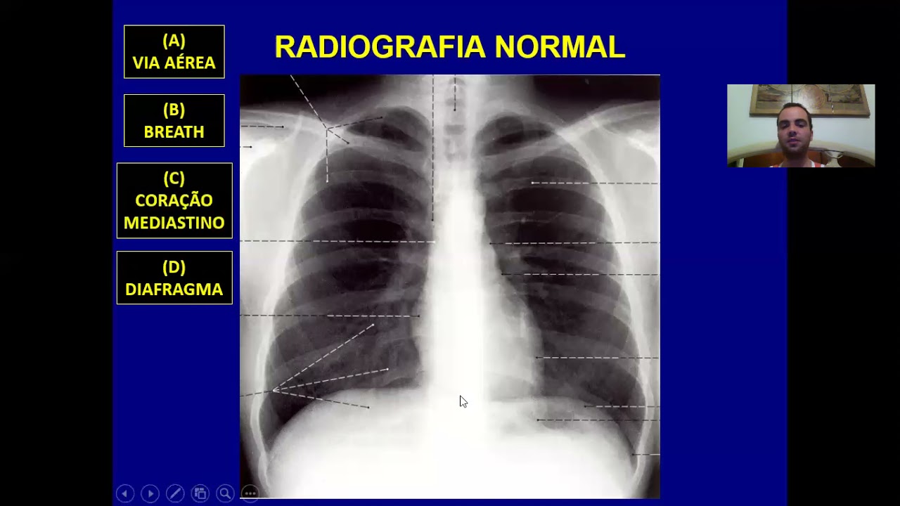 Introdução ao Raio X de tórax + Síndromes pleuropulmonares