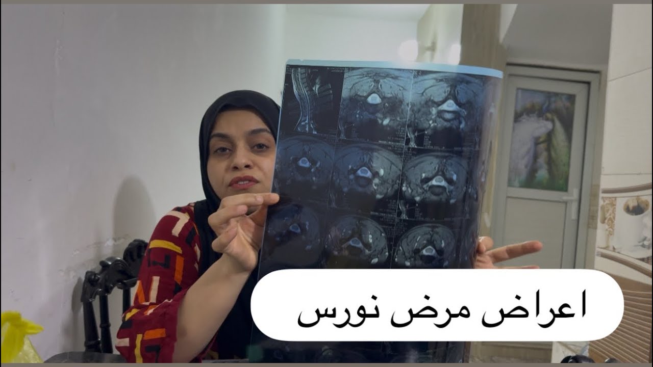 تعبت 😪 و راح اسولفلكم شنو المرض اللي بيه 💔