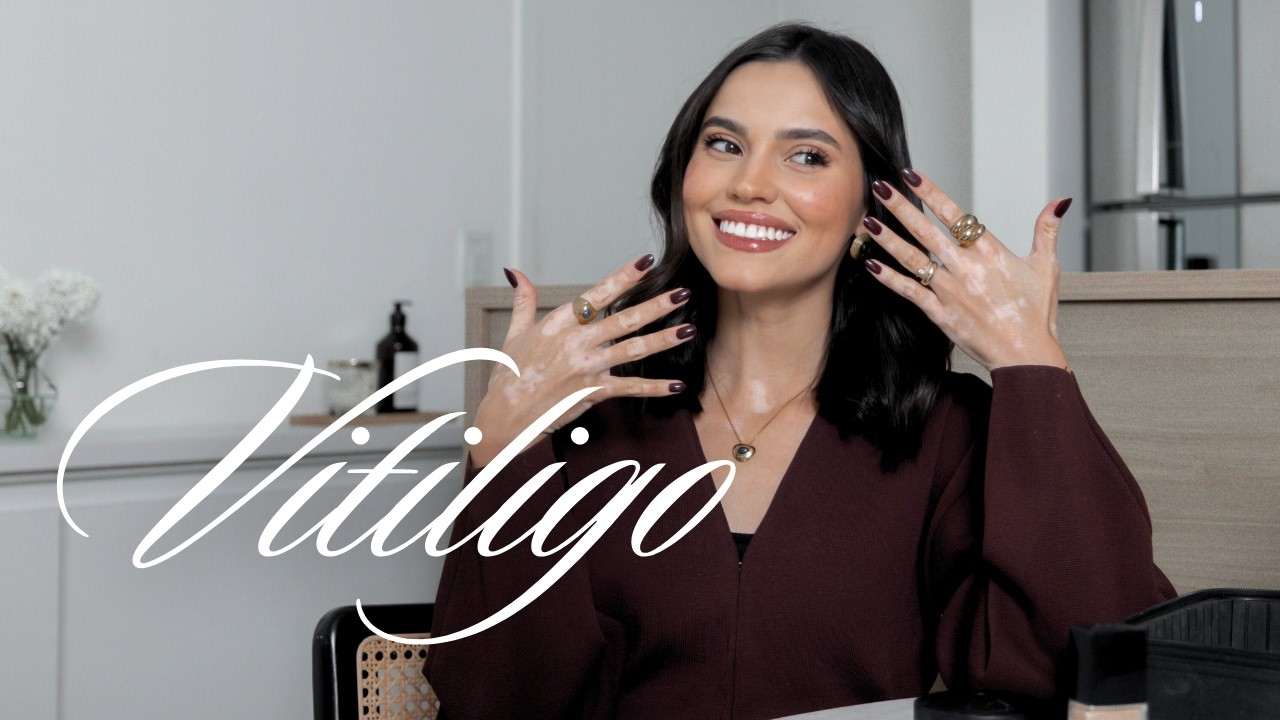 Minha história com o Vitiligo | Maquia e fala