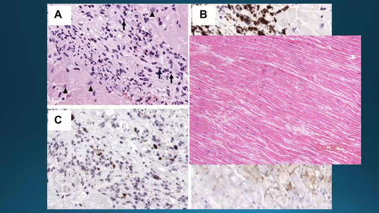 Cardio-oncology: Chemotherapy-related left ventricular dysfunction