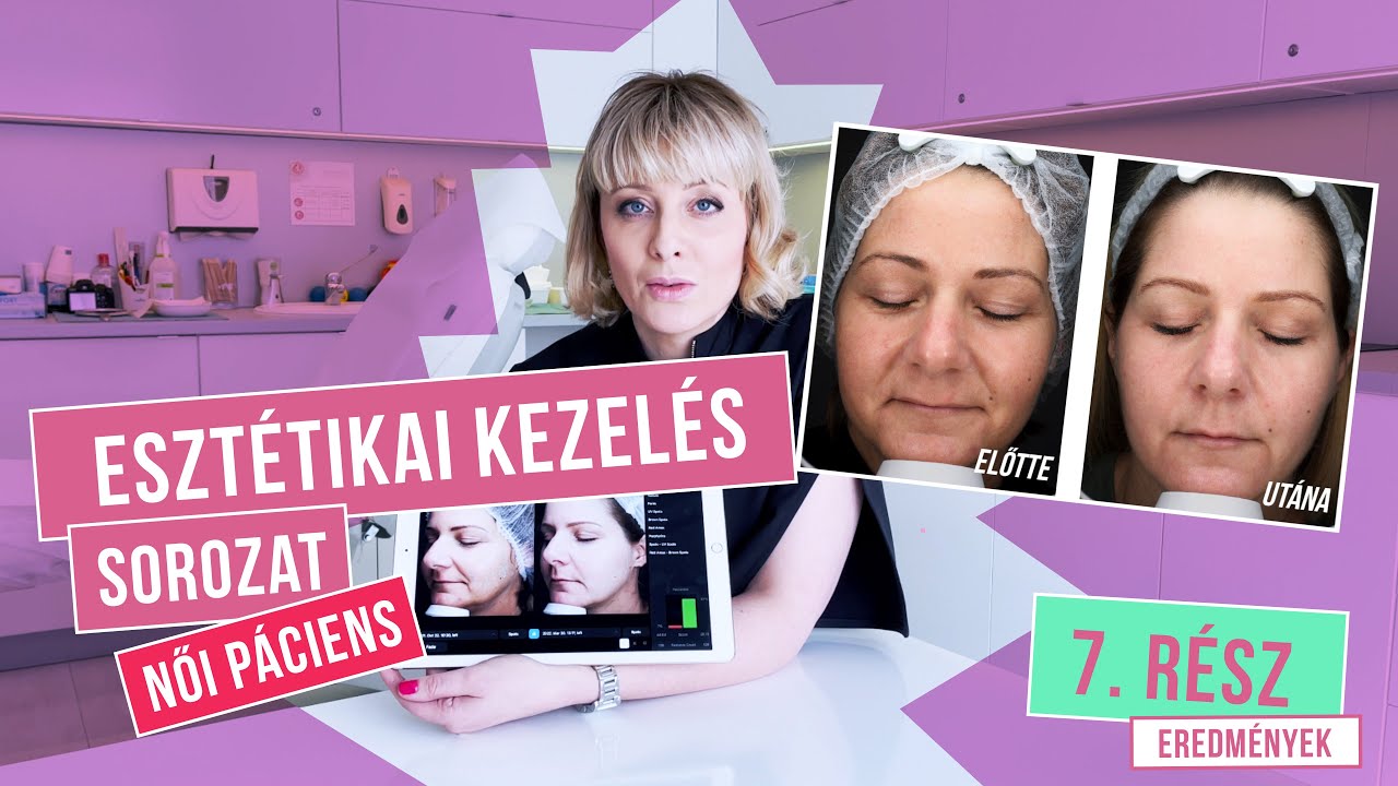EREDMÉNYEK - ESZTÉTIKAI KEZELÉS SOROZAT NŐI PÁCIENSEN (Dóri, 40) - 7. rész